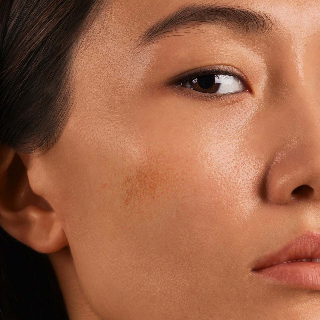 Acne